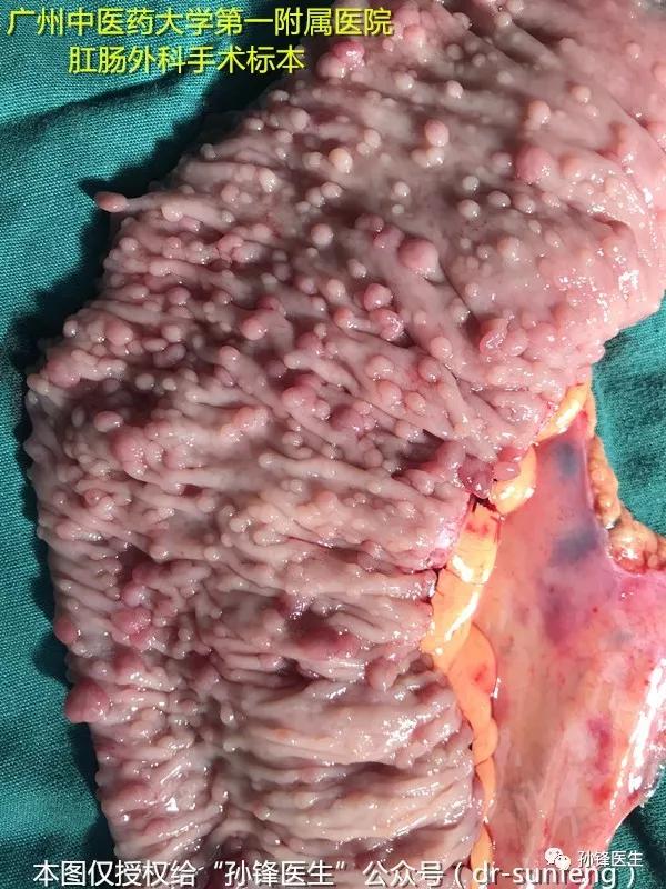 家族性腺瘤息肉病内镜治疗,家族性腺瘤息肉中医