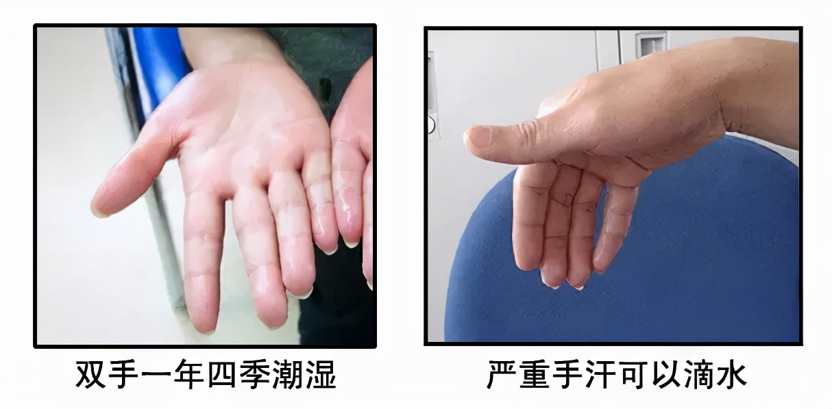 20多年的手汗症终于好了,手汗困扰多年