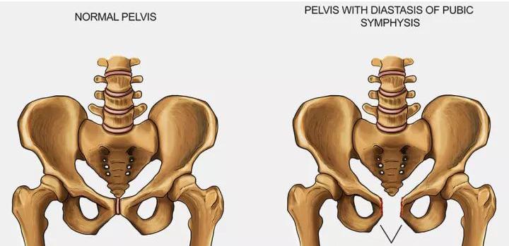 产后腰痛的原因及相关处理方法,产后腰痛是月子没有坐好吗