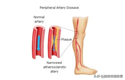小腿疼痛的原因和治疗原则,小腿窝疼痛是什么原因造成的