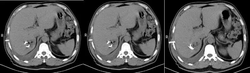 主任医师查房：这个“肺空洞”不简单