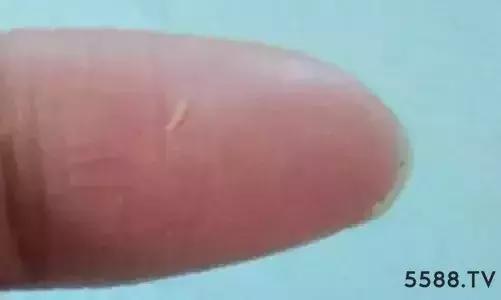 长脂肪粒是不是皮肤屏障受损,长脂肪粒不是眼霜的问题吧