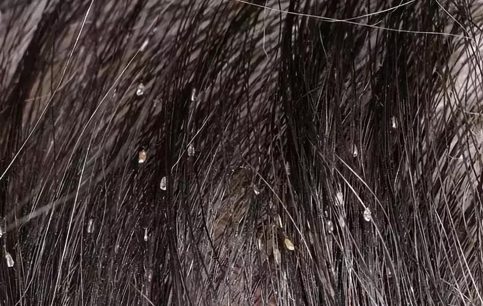 孩子头发上有小白屑是什么,孩子头发上好多白点点是虱子吗