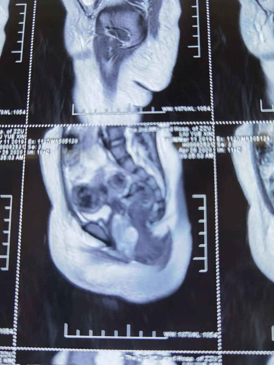 1岁女婴罕见病因,几岁的女孩子怎么会得恶性肿瘤呢