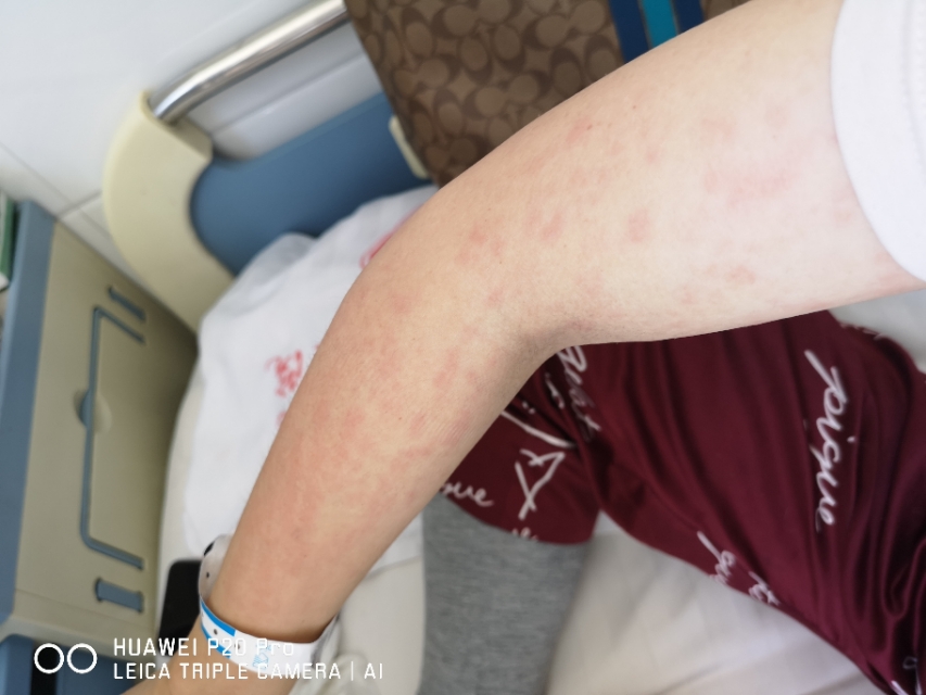 斯蒂尔综合症倪海厦,斯蒂尔综合症如何确诊