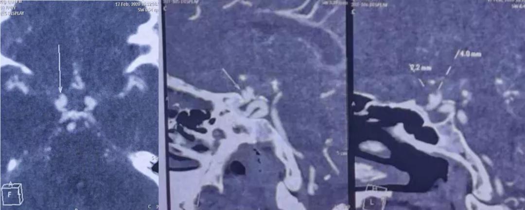 突然头疼要炸了怎么回事,睡觉突然头疼剧烈要炸了