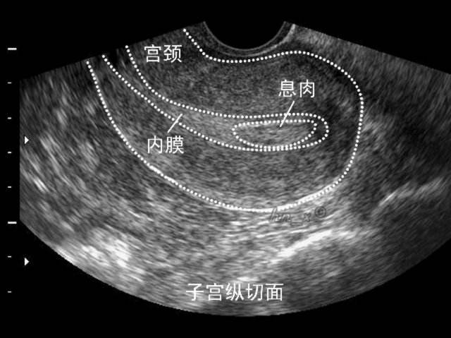 怎么会引起内膜增厚,颈动脉分叉处内膜增厚
