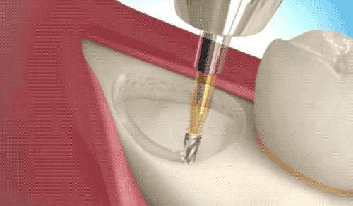 拔智齿是怎么算收费的,拔智齿是按智齿个数收费吗