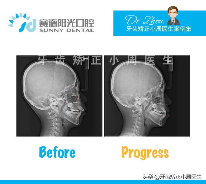 下巴后缩整容玻尿酸还是假体,如何不靠整容改变下巴