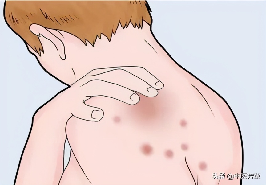 荨麻疹中医有哪些治疗方法,麻疹中医辨证分型及方药