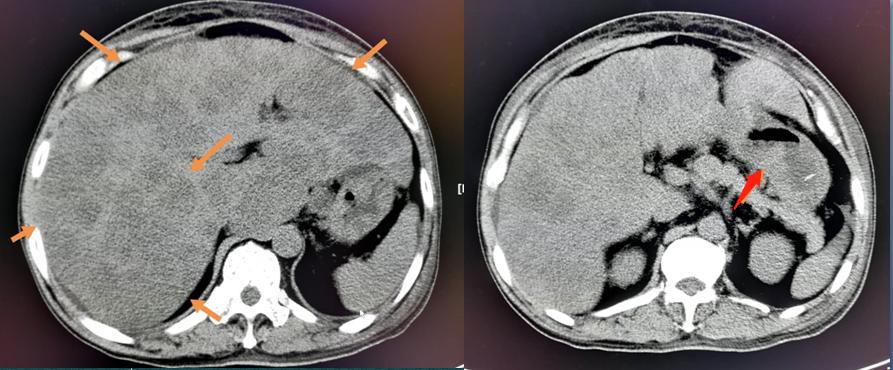 揭秘暴饮暴食引发的疾病,暴饮暴食又吃辣对身体有啥伤害