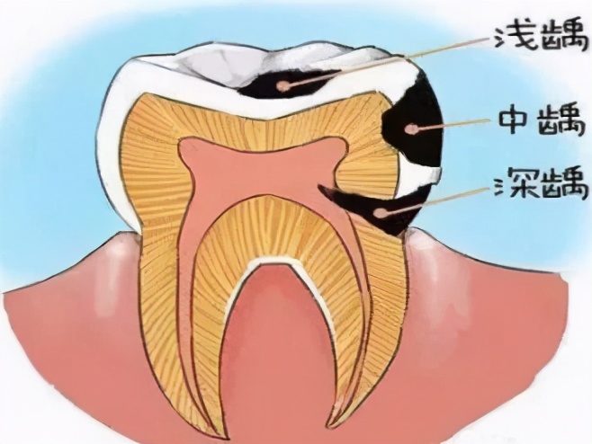 牙痛吃甲硝唑就可以了吗？