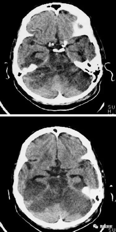脑梗死丨演变、血供区域分布、CT表现