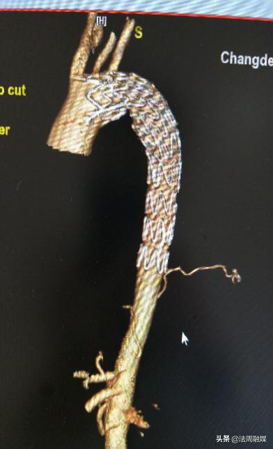 岳阳市一医院主动脉夹层手术,介入微创治疗a型主动脉夹层