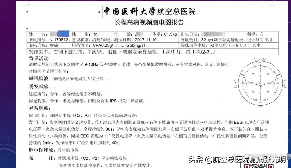 张光明左颞叶癫痫手术成功率,张光明谈治疗癫痫的方法有哪些