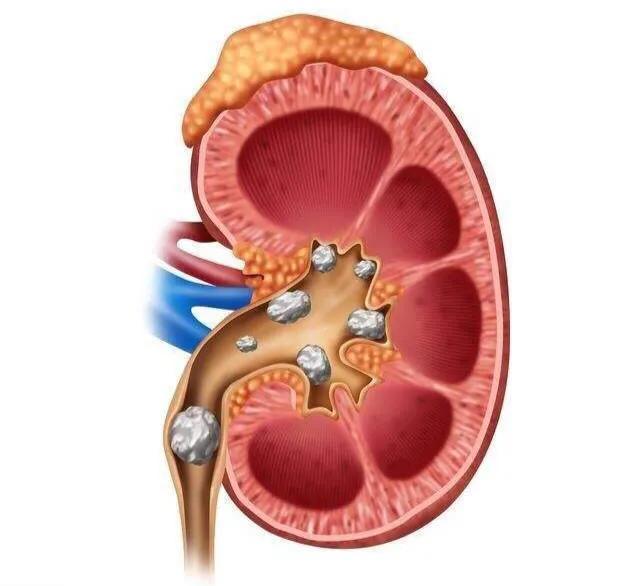 尿路结石治疗方法,女性尿路结石的治疗方法有哪些