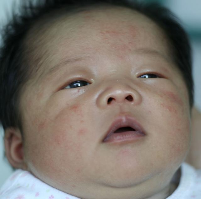 宝宝湿疹反复发作被折磨的睡不着,宝宝湿疹妈妈需要干预吗