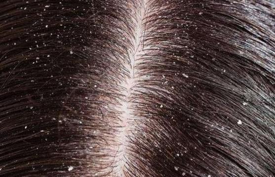 大块头皮屑诱因,突然无明显诱因起头皮屑了