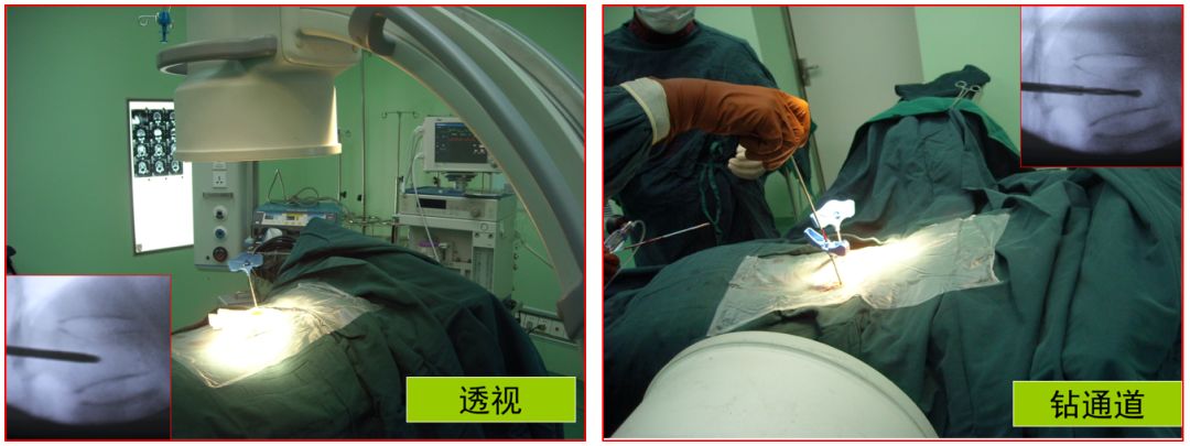 腰椎压缩骨折椎体成形术啥时候做,骨质疏松骨折椎体成形术操作步骤