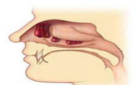 鼻内镜手术一般几天出院,鼻内镜术后病情观察啥