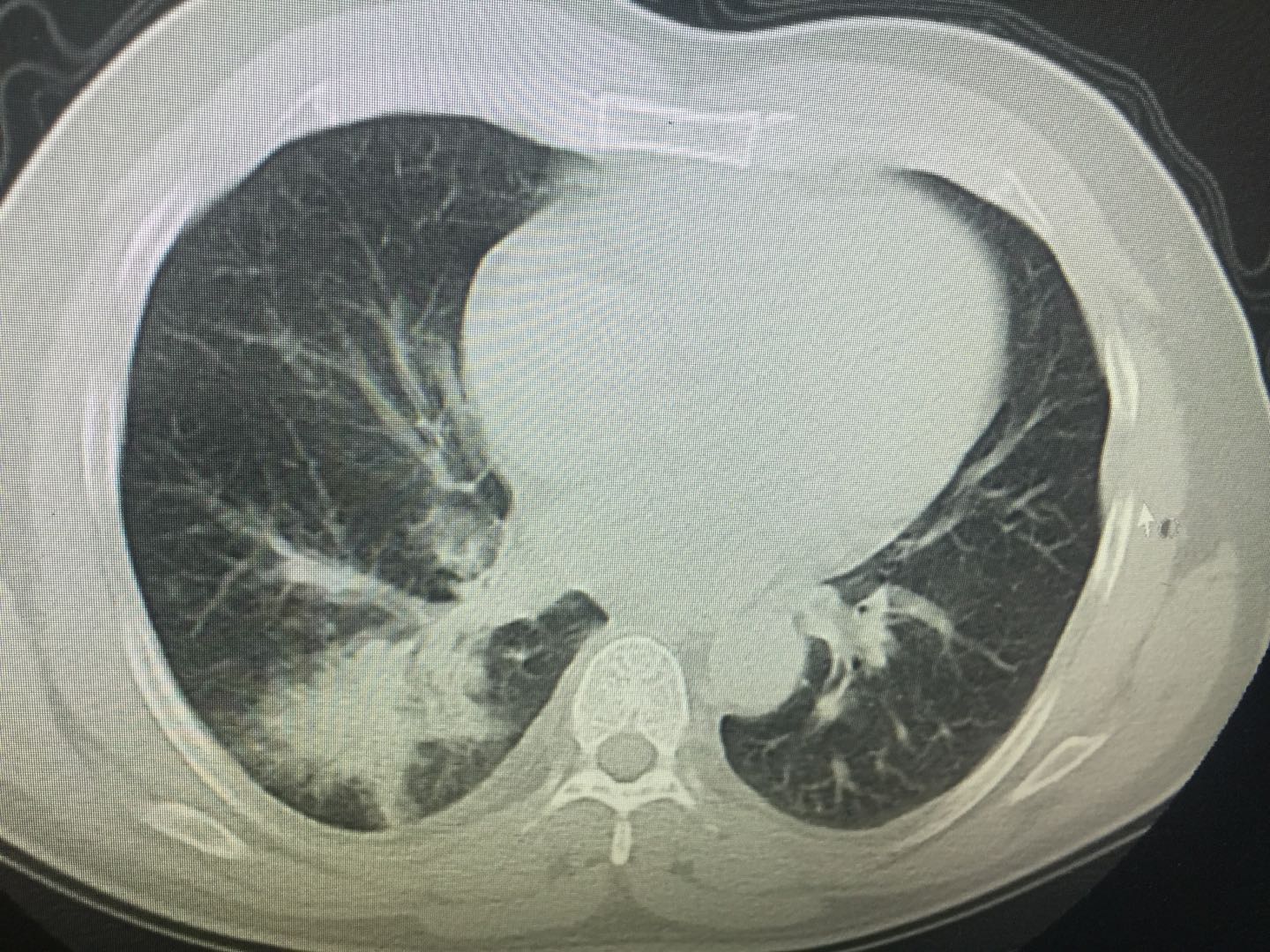 晨起痰中带血原因,用力咳嗽痰中带血
