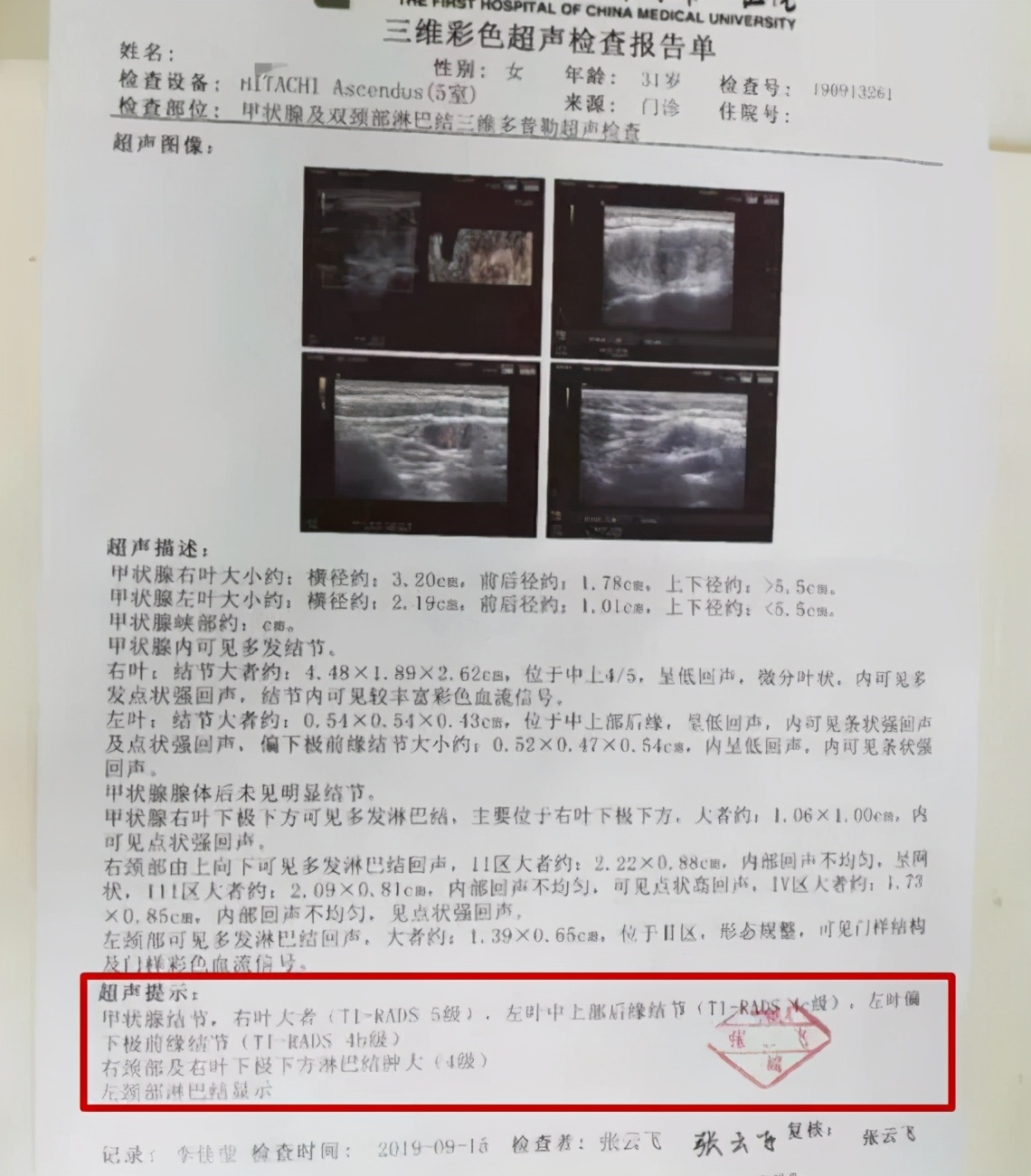 甲状腺结节时间长会转变成癌症吗,两个甲状腺病灶算不算严重