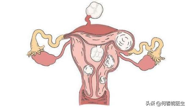 发现子宫肌瘤怎么办？该如何阻止其恶变行为？