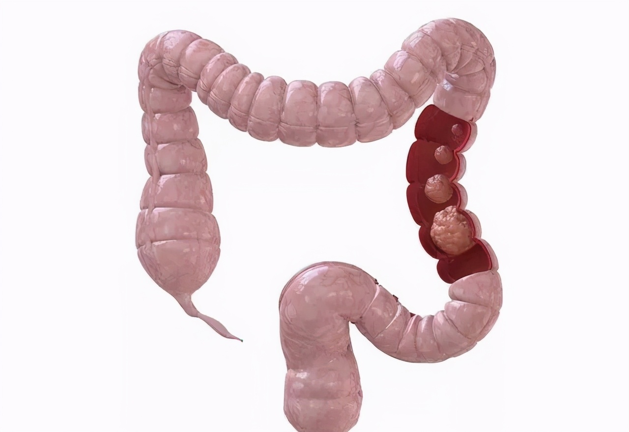 极限憋屎,人类憋屎极限是多少