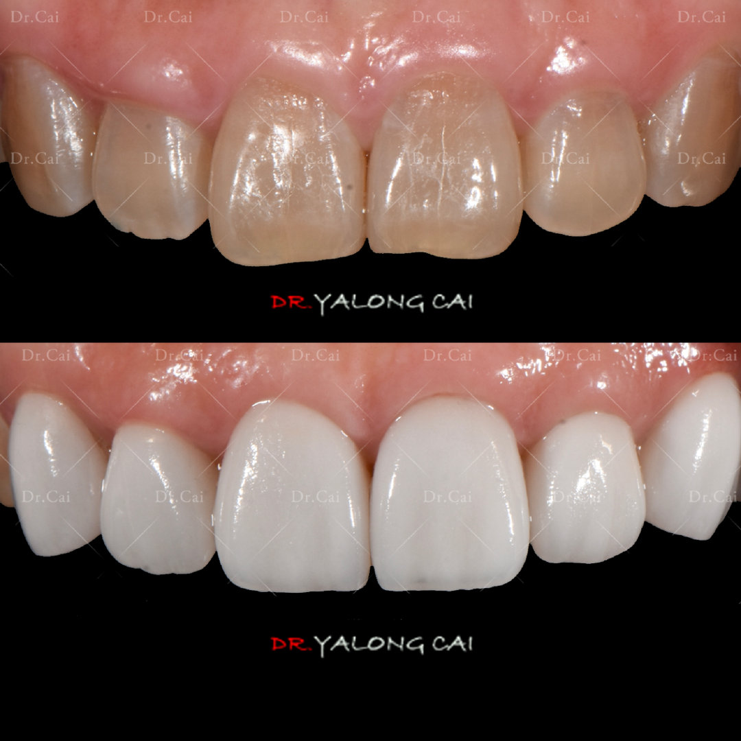 树脂贴面和烤瓷贴区别,贴面树脂的好还是烤瓷的好