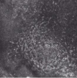 女儿得了银屑病怎么办,宝宝湿疹和银屑病区别