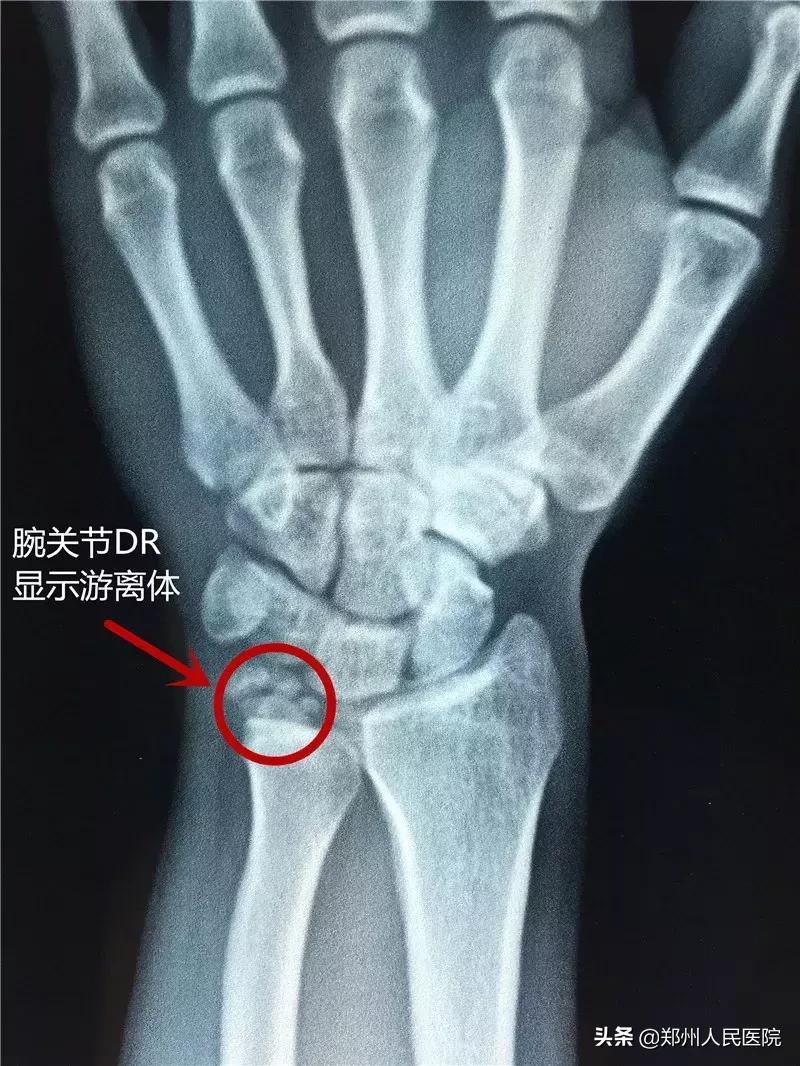 手腕疼10年了怎样治疗,20岁小伙手腕关节疼痛是怎么回事