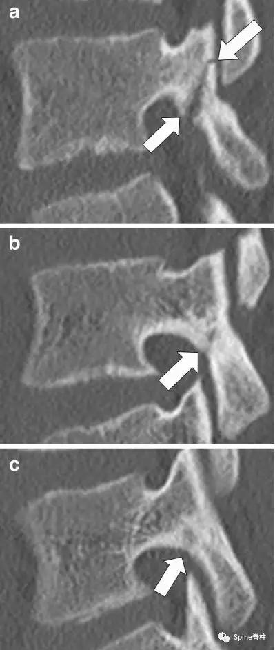 青少年一跑步就腰痛,青少年腰痛是什么原因引起的