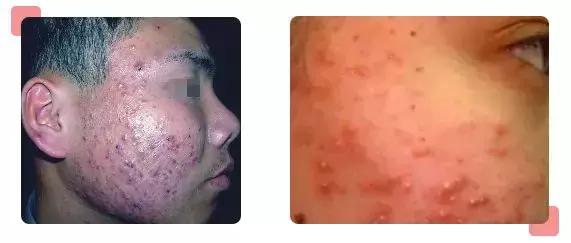 受重度*疮痤**、难治性*麻疹荨**、带状疱疹困扰的朋友看过来