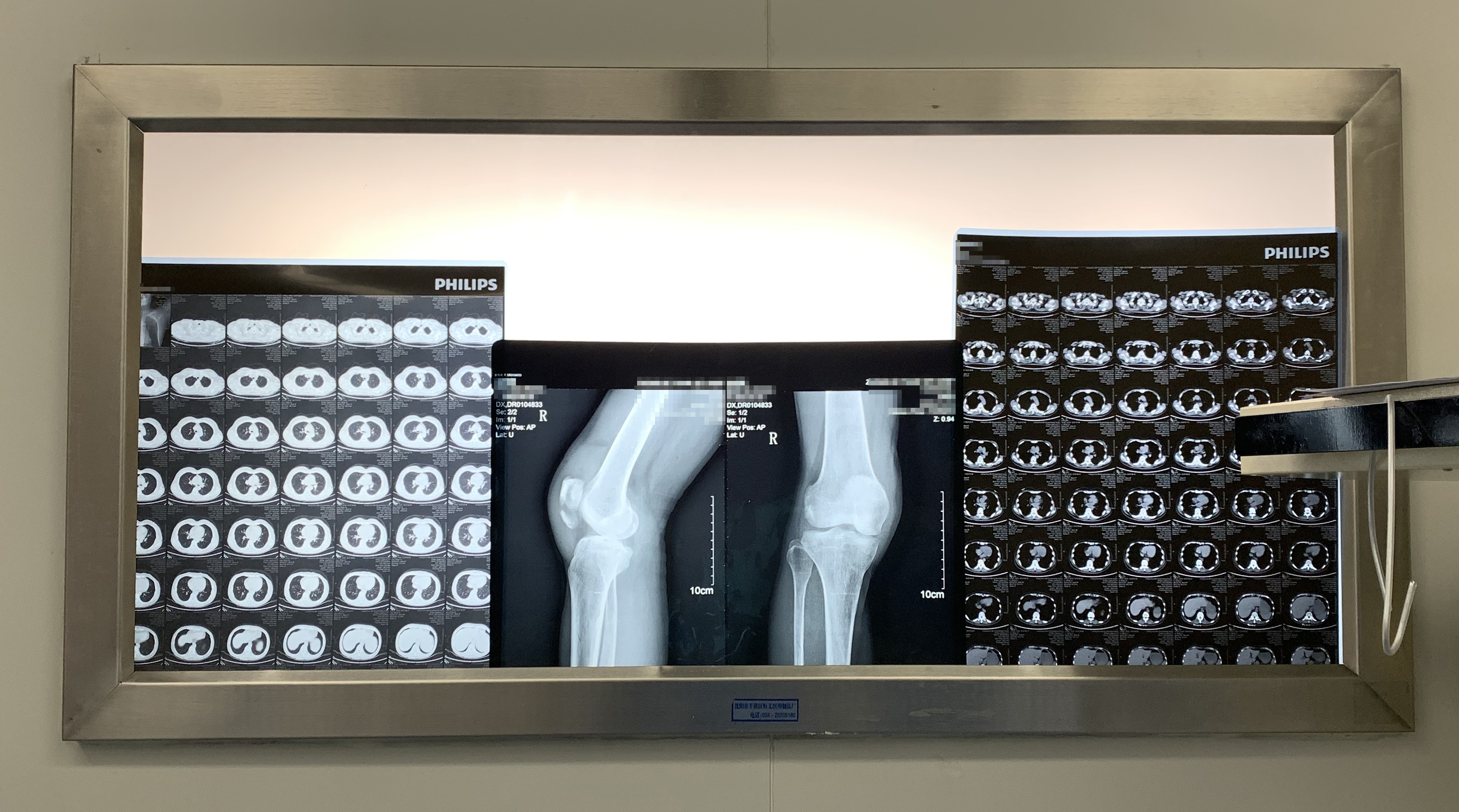 长春传染病医院艾滋病,国内首例艾滋病患儿换肾手术成功
