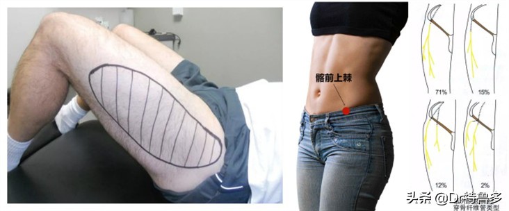 大腿内侧疼是压迫哪根神经引起的,大腿内侧神经疼要警惕