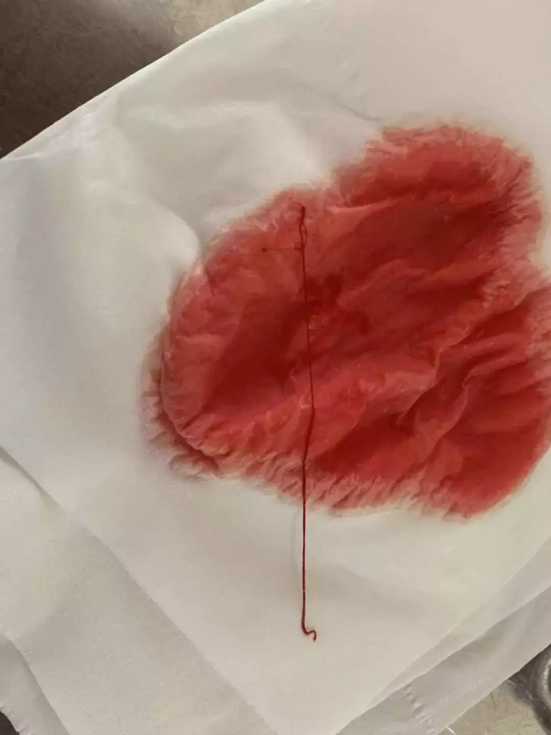 脐静脉置管为什么容易入肝,脐静脉置管误入肝脏怎么办