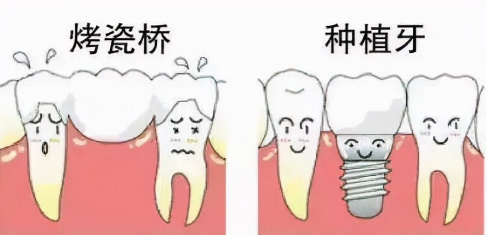 种植牙与假牙的区别是什么,种植牙vs假牙3大牙齿修复方式对比