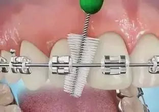 牙齿矫正过程牙套脱落问题,牙齿矫正各种问题以及解决方法
