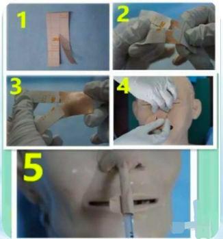 留置胃管的护理记录怎么写,出院后胃管护理宣教