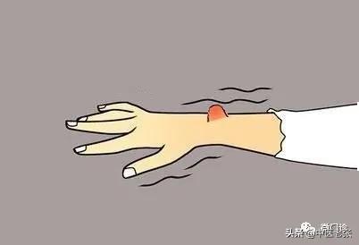 国医大师治“包块”的方子!化解全身痰核、脂肪瘤、结节,请学习