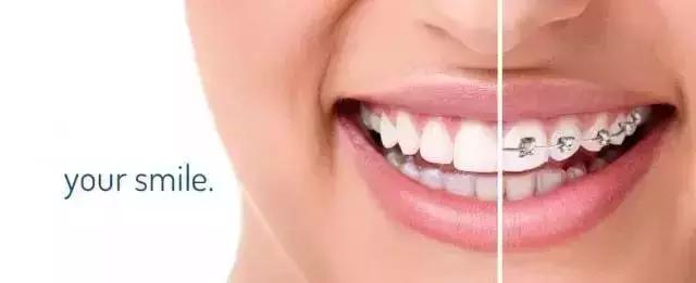 做牙套的工资一般多少,戴个牙套有什么用