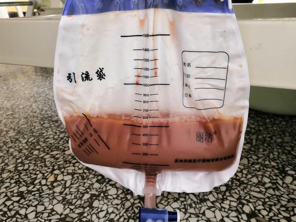 小结石有可能引起潜血吗,小结石引起的肾积水要紧吗