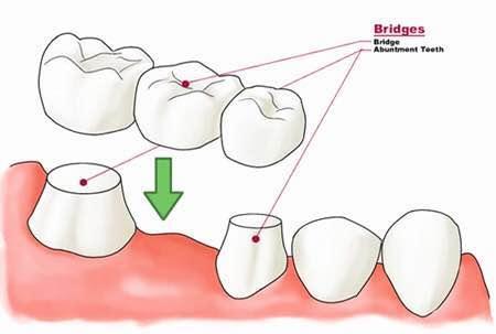 上门牙缺失3颗做牙桥修复方案,缺牙缝隙大能做固定桥修复吗
