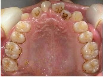 乳牙拔出恒牙不长在原来的位置,孩子的乳牙迟迟不掉怎么回事