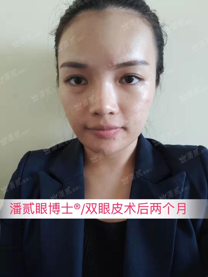 割了开扇双眼皮眼尾上扬太宽,眼尾上扬的眼睛适合什么双眼皮