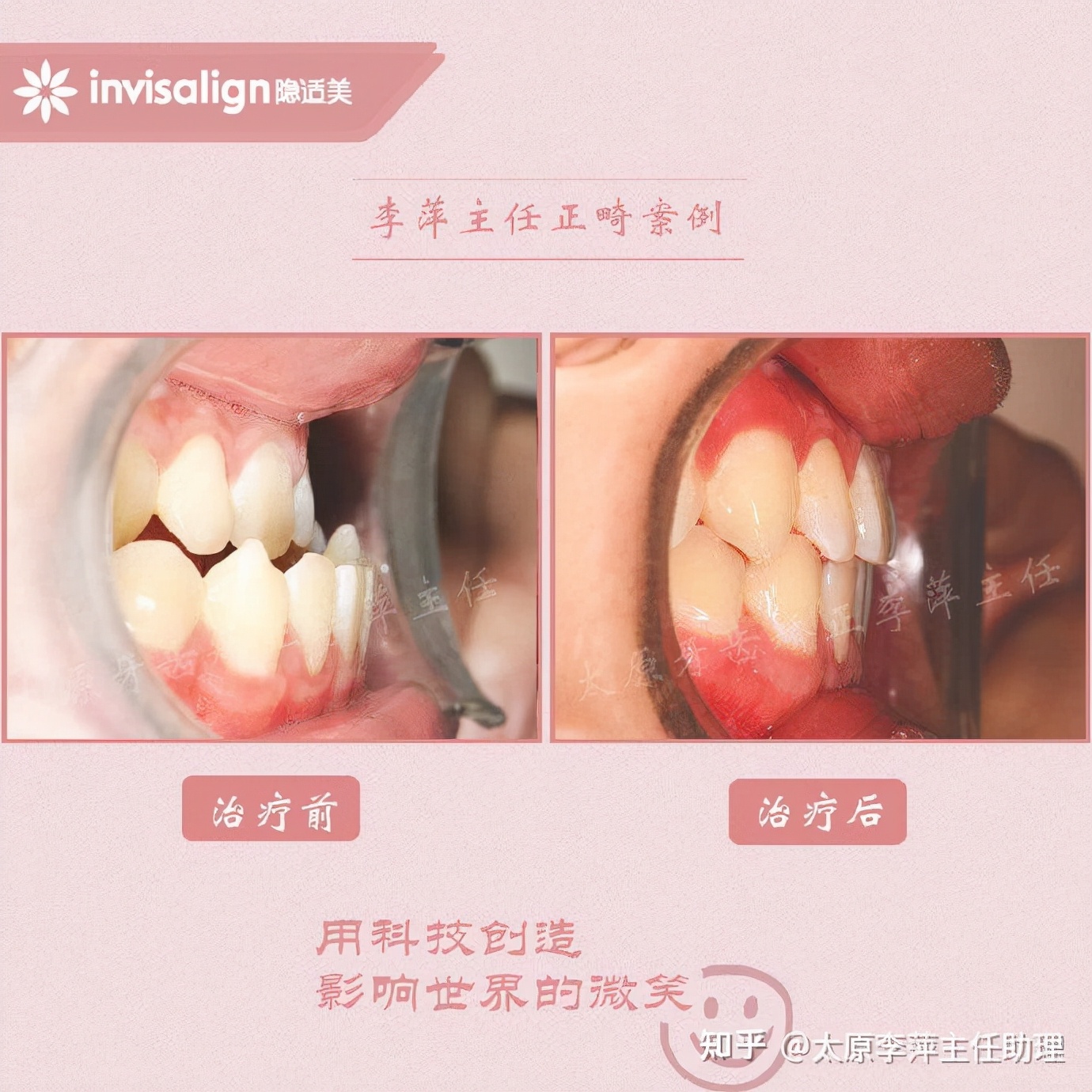 太原牙齿矫正靠谱吗,太原成人隐形牙套牙齿不齐