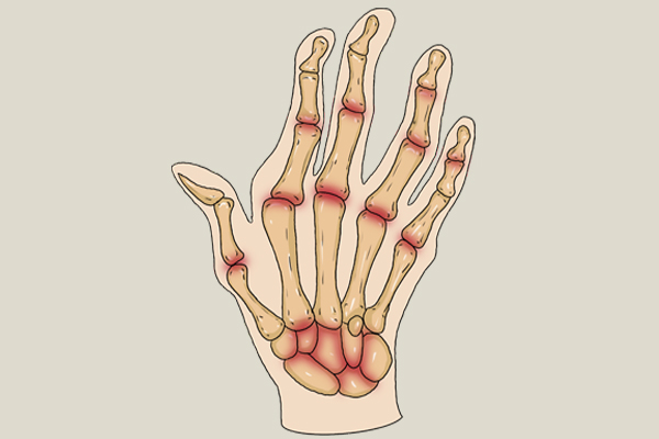 每天早上醒来手指发胀攥不上拳头,早晨醒来双手五指发胀是什么原因