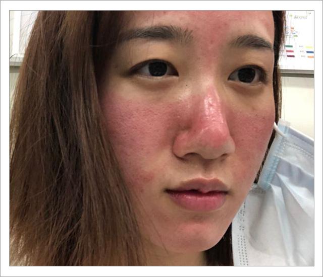 根除脸上螨虫的简单方法,螨虫在脸上如何彻底消除