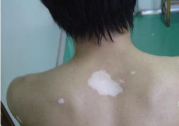 “孩子怕得发抖”！17岁男生成绩下降被逼补习，白癜风让母亲后悔