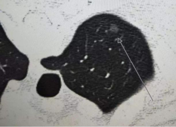 华西廖正银教授治肺结节,华西医院肺癌专家唐小军